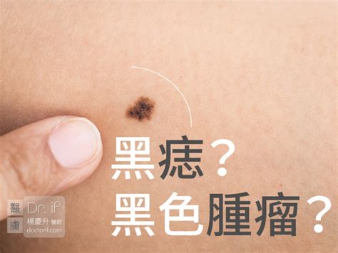 不規則黑痣|不大驚小怪！如何辨別「黑痣」與「黑色腫瘤」？ 